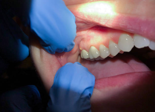 Best Tooth Infection Emergency Dentist  in Mount Olive, IL