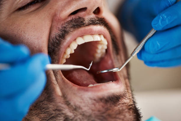 Emergency Dental Filling Replacement in IL